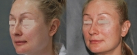 Снимки до и после липофилинга лица у Давида Гришкяна