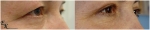 Блефаропластика верхних век, с частичной резекцией порции круговой мышцы глаза. Клиника Doctor Plastic, хирург Кахраманов.