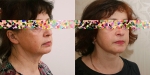 Пациентка Александра Жукова до и после подтяжки лица