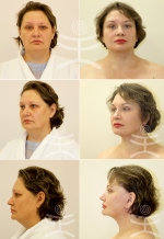 Пациентка доктора В.С. Тарасенко до и после «Лифтинга Мендельсона» 