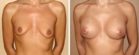 Асимметрия груди. До и после операции. Вадим Баков