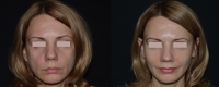 Фото до и после липофилинга лица у Давида Гришкяна