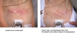 На фото приведены данные исследование Spenser,J, scar study, сделанные в 2008 году.  Использовался Kelo-cote® Solaire. Фото, демонстрирующее результат лечения, сделано спустя 3 месяца после начала терапии.