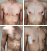 Коррекция врожденной деформации грудной клетки по методу Насса. Хирург —  Кузьмичев В.А.
