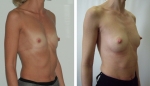 Пациентка доктора Сергеева до и после липофилинга груди