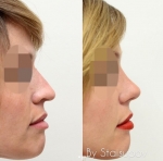 Закрытая ринопластика сложного носа. Сильное опущение кончика носа, пологая горбинка и широкие ноздри