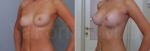 Увеличение груди. Екатерина Вакорина
