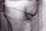После операции по удалению жирового «фартука»