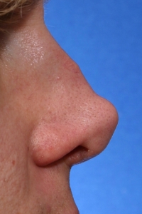 Осложнение кончика носа