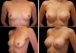 Камкамидзе М.В. Увеличение груди методом баллонной дерматензии
