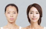 До и после. Пациентка клиники ID Clinic в Сеуле