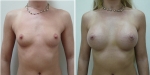 Екатерина Вакорина. Увеличение груди, Ментор, анатомические, 375