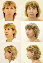 Пациентка доктора В.С. Тарасенко до и после «Лифтинга Мендельсона» 