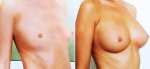 До и после увеличения груди у доктора А.Р. Тваури