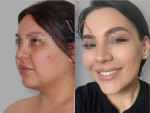 Омоложение лица FaceTite. Доктор Вардан Аршакян