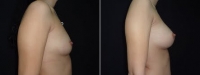 Пациентка до и после увеличения груди. Г.П. Бабаян