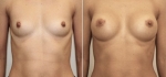 До и после увеличения груди