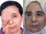 Самира Бенхар до и после пластической операции