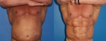 Операция «BodyBanking». Фото до и после