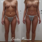 VASER Lipo передней брюшной стенки, спины, подмышечных областей, плеч, бедер, коленок