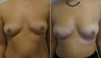 До и после липофилинга груди у Арслана Пенаева