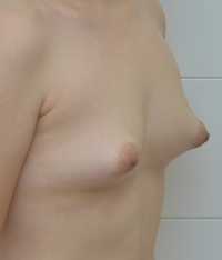 Тубулярная грудь