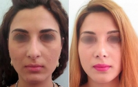 Мой нос до и после ринопластики у Али Алиева
