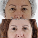 Омоложение области век, пациентка доктора А.А. Пенаева