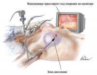 Метод эндоскопического увеличения груди