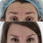 Пациентка доктора А.А. Пенаева до и после процедуры «Вечный Ботокс»