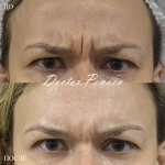 Пациентка доктора А.А. Пенаева до и после процедуры «Вечный Ботокс»