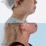 Эндолазерное омоложение шеи, пациентка доктора А.А. Пенаева